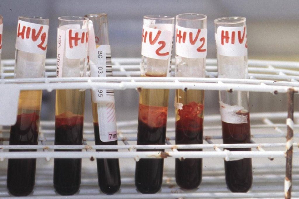 Aids, scoperti ‘codici’ del sistema immunitario per sospendere le cure