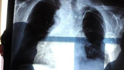 Polmonite ogni anno in Italia 150mila ricoveri e 9mila morti i sintomi