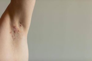 Idrosadenite suppurativa, appello esperti ‘sia inserita nel Piano delle cronicità’
