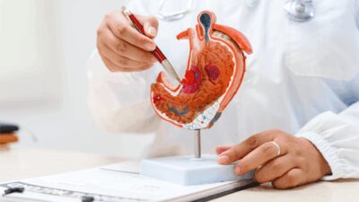 Tumore allo stomaco pazienti Diagnosi precoce per meno di 1 su 5 migliorare percorsi