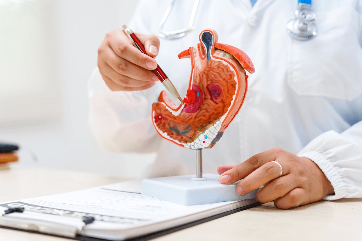 Tumore allo stomaco pazienti Diagnosi precoce per meno di 1 su 5 migliorare percorsi